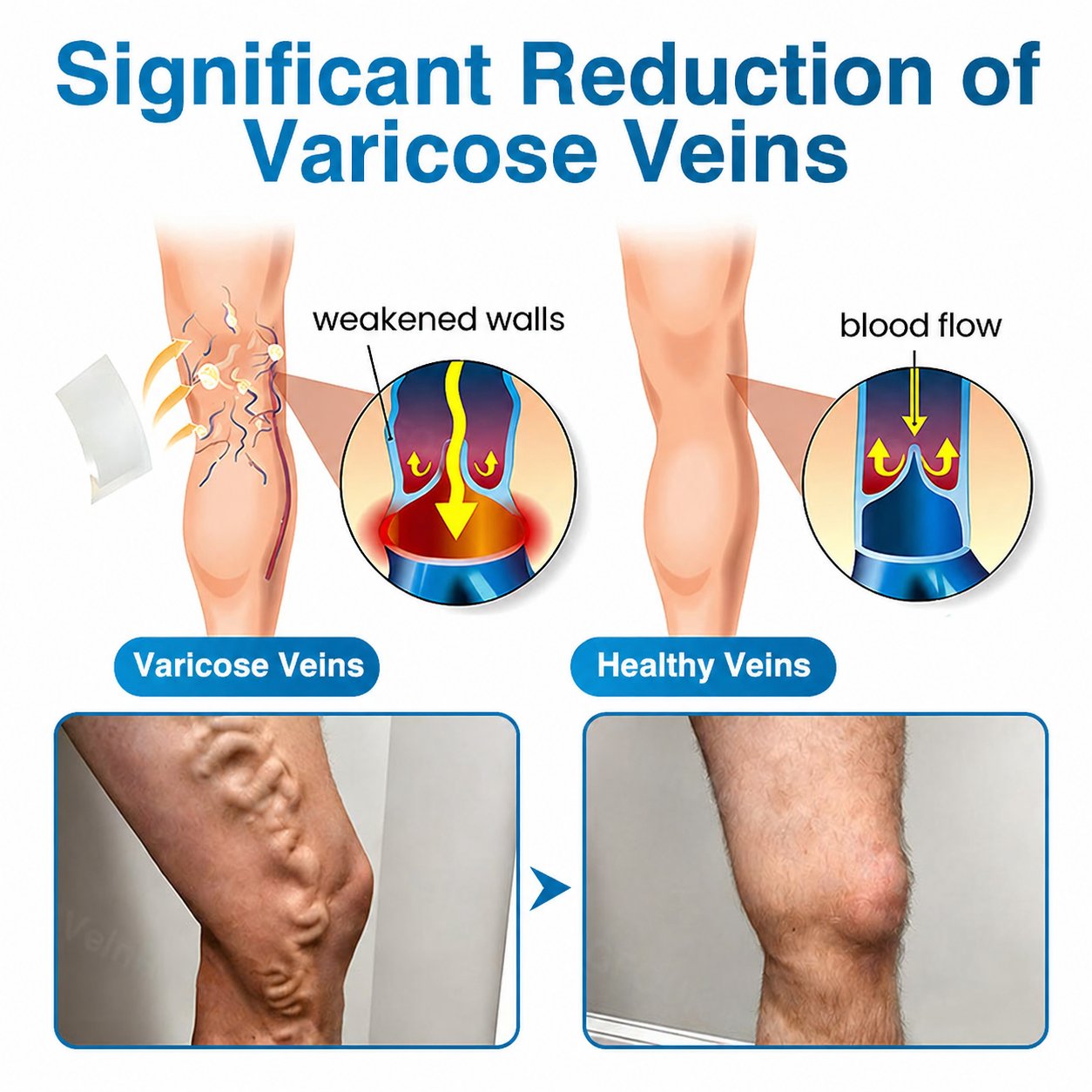Virexo™ VeinRepair Microneedle Patch Roll⚡Instant Relief, Long-Term Results